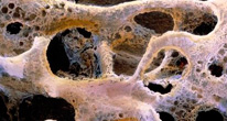 Лекарство от остеопороза защищает стволовые клетки