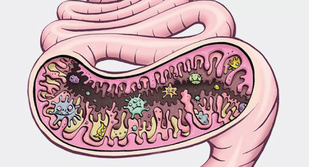 дисбактериоз