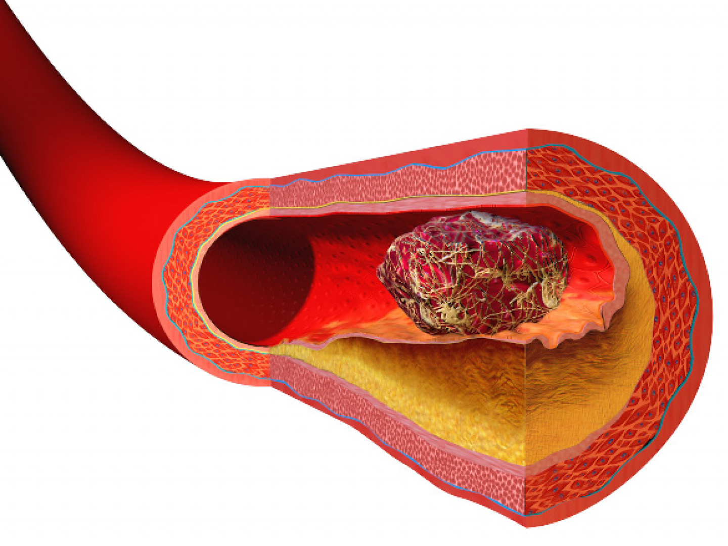 Препарат который растворяет тромбы в кровеносных сосудах. Как избежать тромбов в сосудах. Кровяной тромб