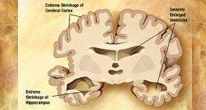 Растворение амилоидных бляшек останавливает болезнь Альцгеймера
