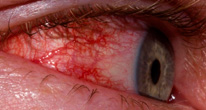 Вирус Зика может повреждать глаза