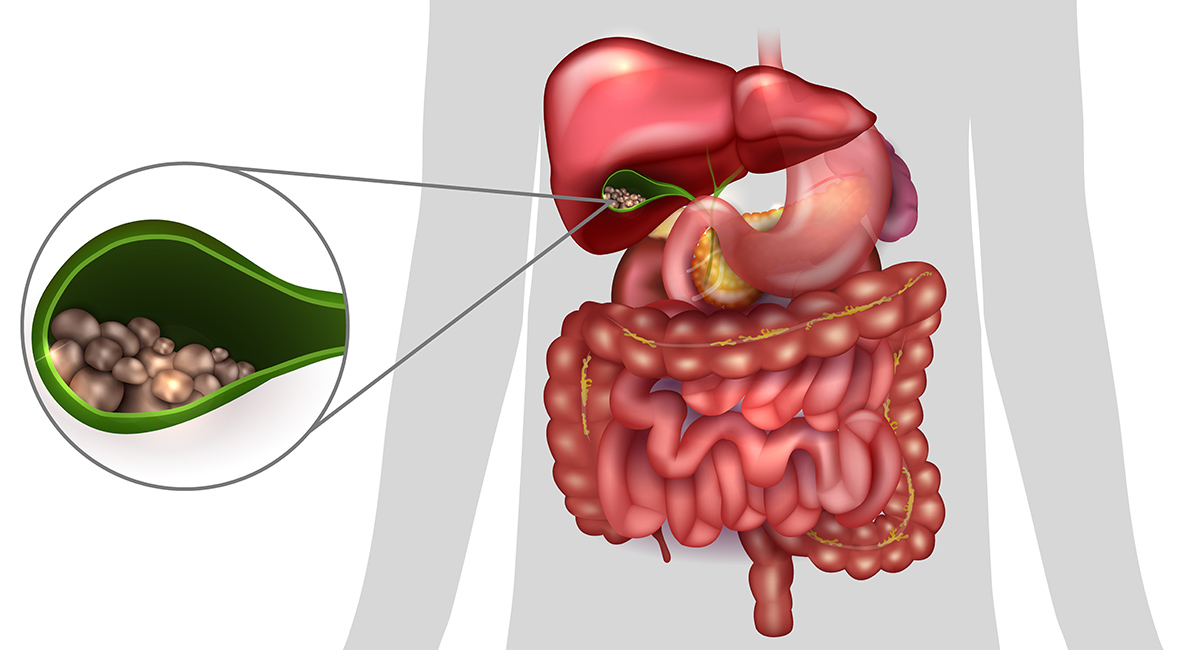 Желчнокаменная болезнь