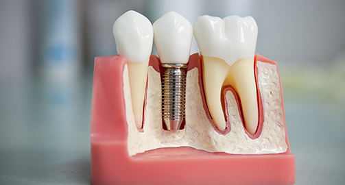 Импланты зубов: все за и против 