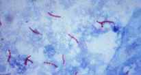 Эпидемия туберкулеза серьезнее, чем считалось