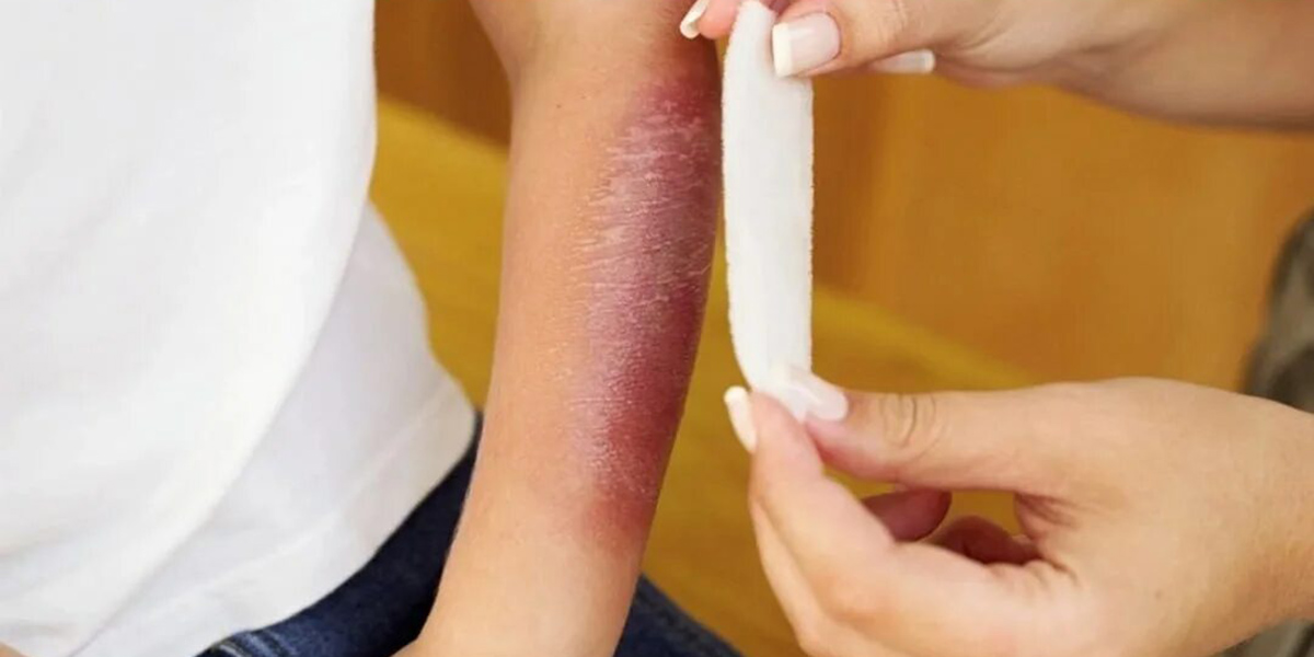 если ребенок обжегся или получил солнечный удар если ребенок обжегся или получил солнечный удар