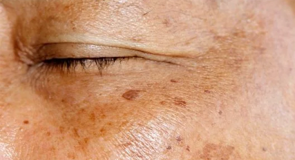 Гиперпигментация кожи