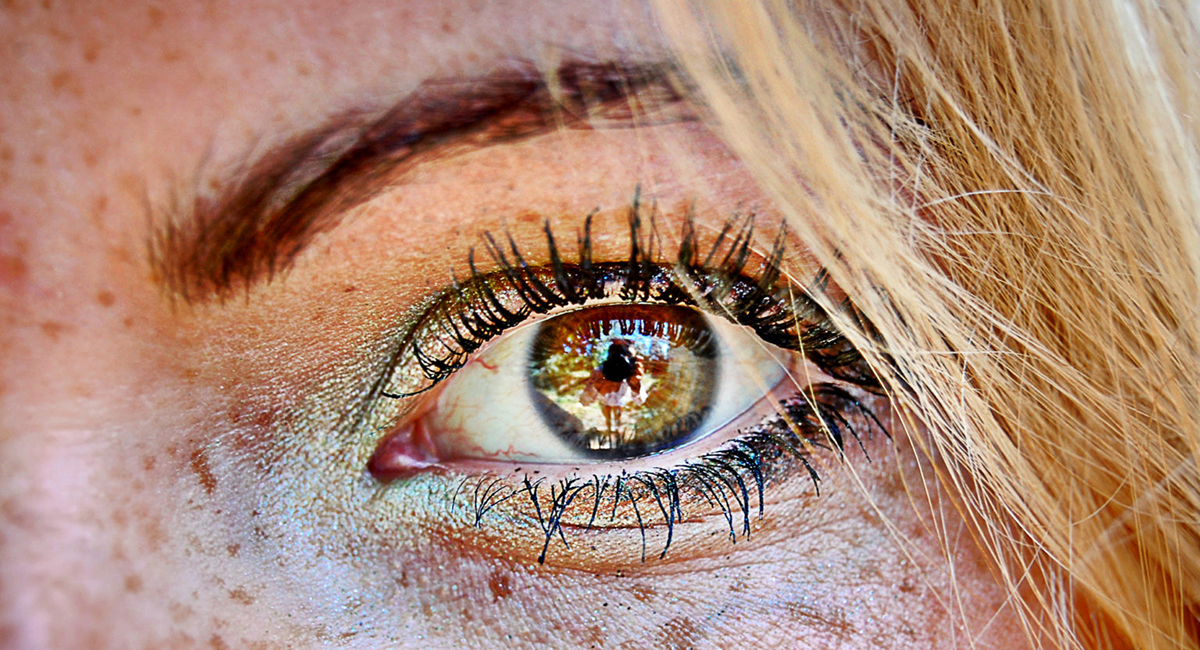 Гиперпигментация кожи Гиперпигментация кожи