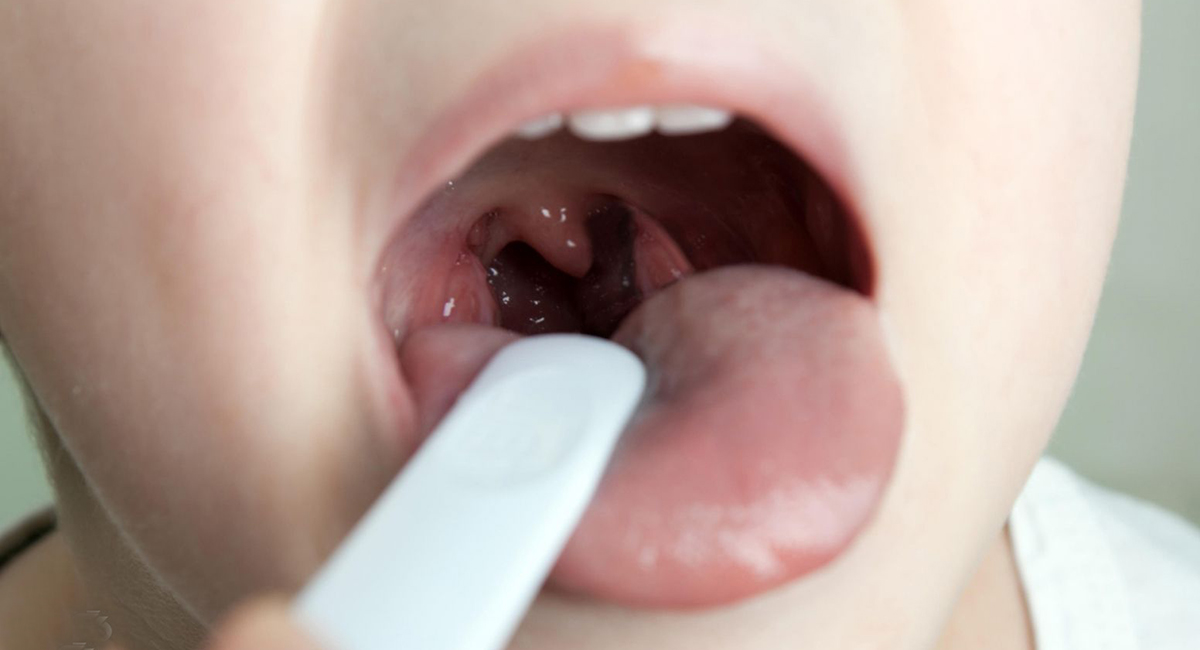 Ангина у детей Ангина у детей