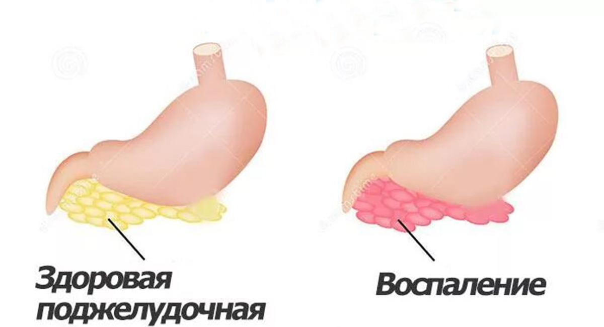 Болезни поджелудочной железы
