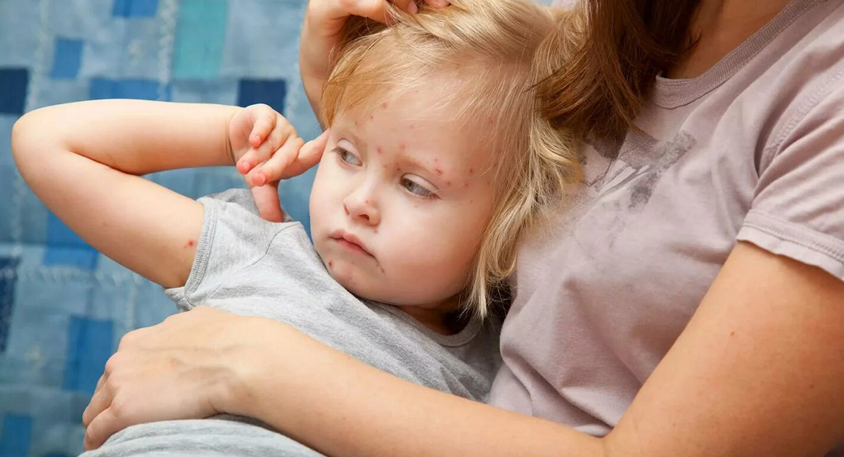 розеола детская