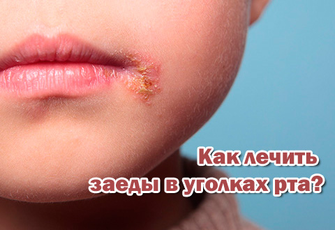 Как лечить заеды в уголках рта?