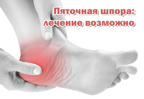Пяточная шпора: лечение возможно