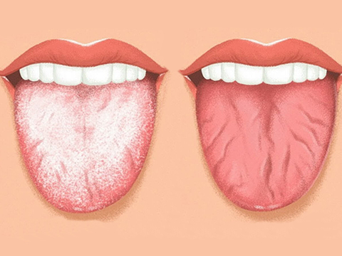 Как убрать (удалить) налет с языка - как и чем чистить язык от налета
