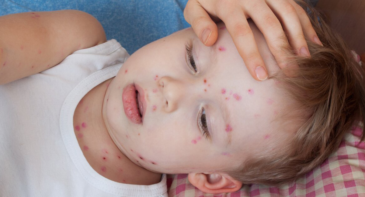 розеола детская