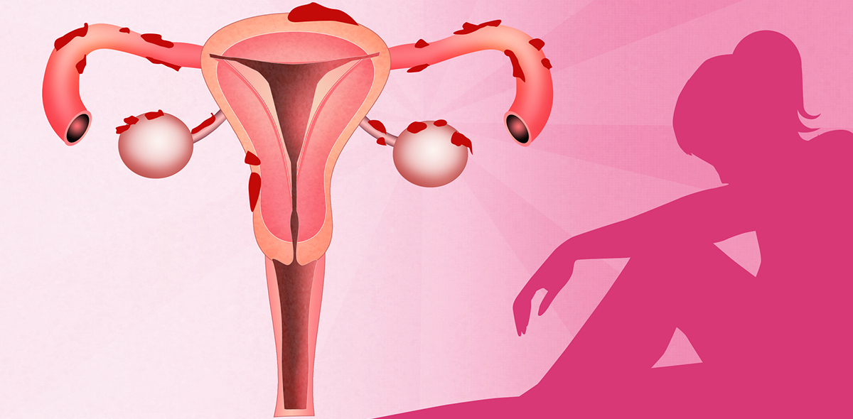 Женские половые органы яичник. Эндометриоз матки гинекология. Заболевание матки эндометриоз. Женская гинекологическая болезнь эндометриоз.