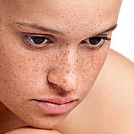 Гиперпигментация кожи, можно ли бороться